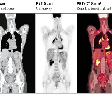 PETCT