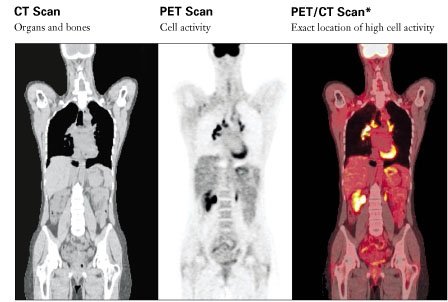 PETCT